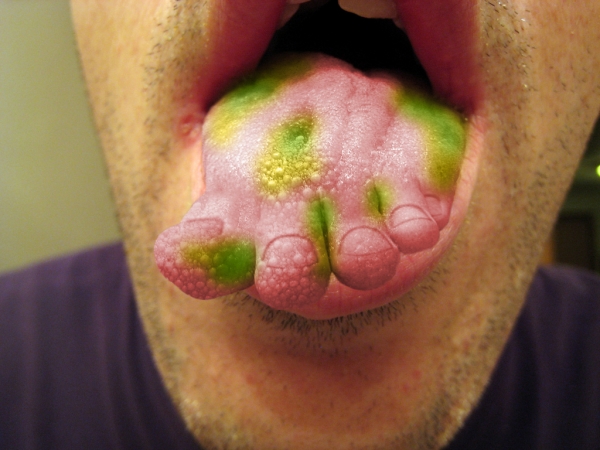 Creation of Do I Have Athlete's Tongue?: Step 5